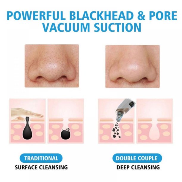 Electric Blackhead Remover Pore Vacuum – 3 Suction Levels, 5 Heads & USB Rechargeable Facial Cleaner