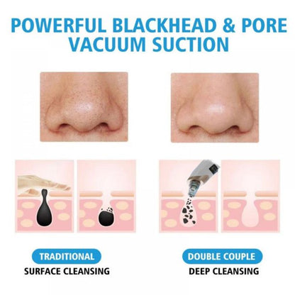 Electric Blackhead Remover Pore Vacuum – 3 Suction Levels, 5 Heads & USB Rechargeable Facial Cleaner